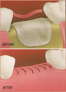 Extrations and bone grafts Extrations and bone grafts Fresno CA