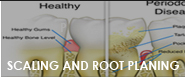 scaling and root planing fresno ca