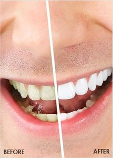 Teeth Whitening Fresno Teeth Whitening Fresno
